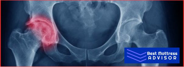 Hip bursitis