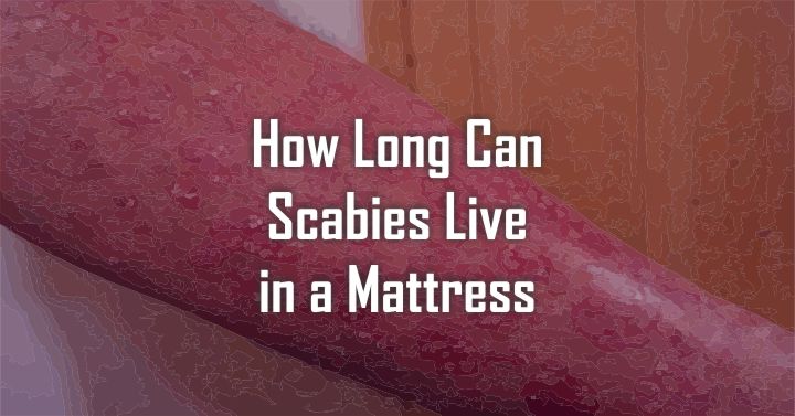 How Long can Scabies live in a Mattress